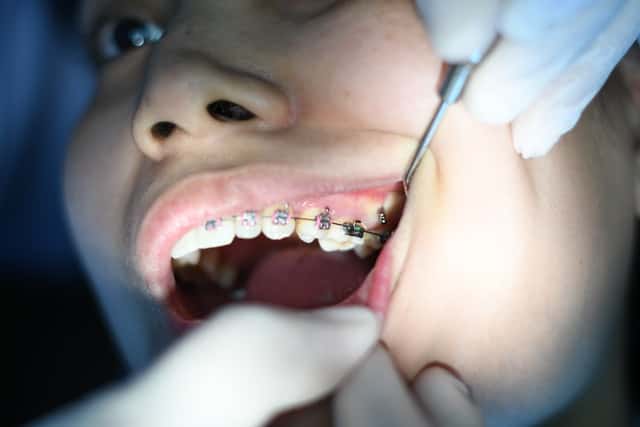 braces in gambia